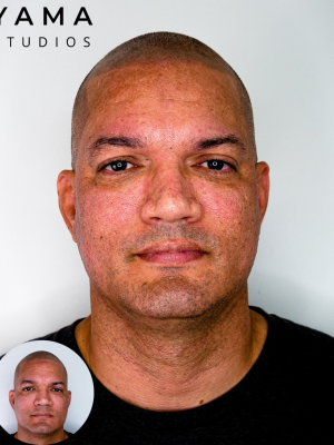Scalp micropigmentation hair tattoo old SMP cover up at YAMA Studios on Oahu in Honolulu, Hawaii.