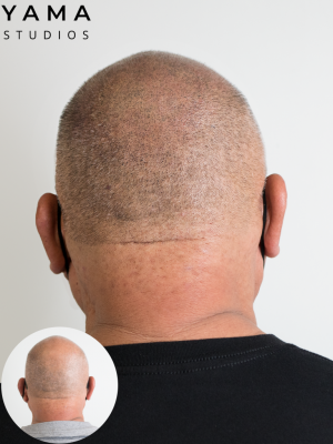 website-man-losing-hair-gets-scalp-micropigmentation-honolulu-hawaii-yama-studios-before-and-after